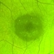 Cone Dystrophy